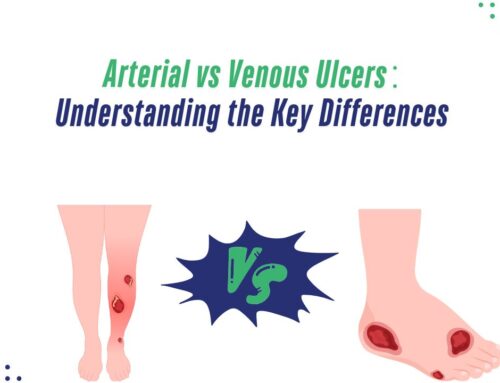 Arterial vs. Venous Ulcers: Understanding the Key Differences – 2025